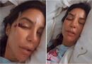 Ivete Sangalo mostra rosto com ferimentos após desmaiar em casa