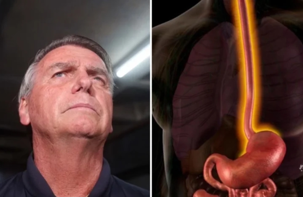 Entenda a doença diagnosticada em Jair Bolsonaro
