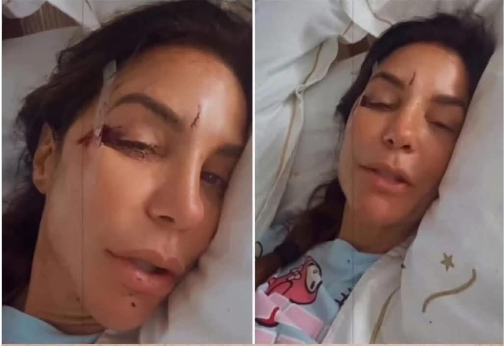 Ivete Sangalo mostra rosto com ferimentos após desmaiar em casa